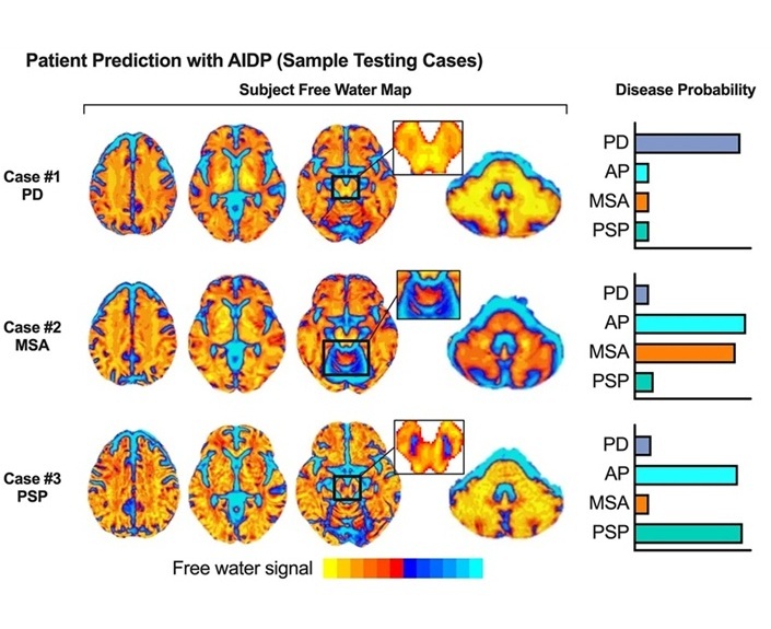 Image: The automated MRI processing and machine learning software features a noninvasive biomarker technique (Photo courtesy of University of Florida)