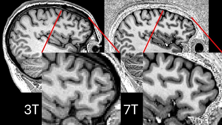 Image: Comparison showing 3T and 7T scans for the same participant (Photo courtesy of P Simon Jones/University of Cambridge)