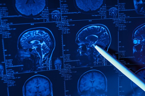 Image: An AI tool has shown tremendous promise for predicting relapse of pediatric brain cancer (Photo courtesy of 123RF)