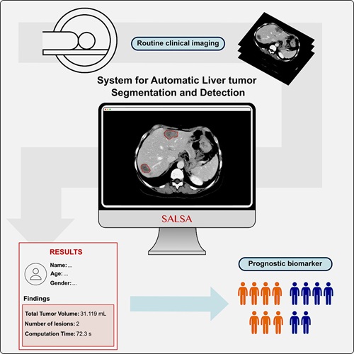 Image: SALSA is a new artificial intelligence tool for the automated and precise analysis of liver tumors (Photo courtesy of VHIO)