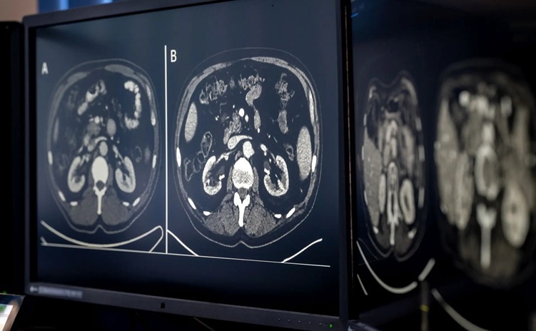 Image: CT scans are routinely taken during cancer treatment (Photo courtesy of Astrid Eckert/TUM)