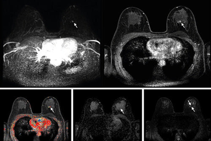 Image: Abbreviated axial MRI images show a 7-mm irregular mass with irregular margin (Photo courtesy of Radiology)