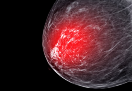 Image: AI for decision support improves radiologist performance by increasing sensitivity for breast cancer detection (Courtesy of 123RF)