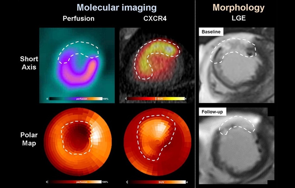 Image: CXCR4-targeted PET imaging reveals hidden inflammatory activity (Diekmann, J. et al., J Nucl Med (2025). DOI: 10.2967/jnumed.125.270807)