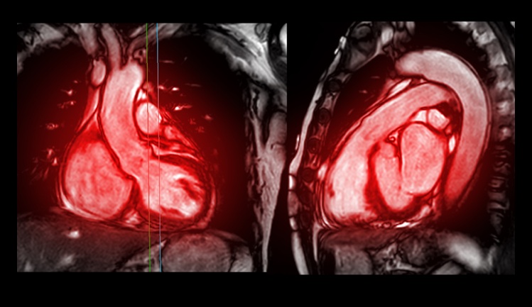Image: A standard cardiac MRI could provide critical oxygen measurements without invasive catheter procedures (Photo courtesy of 123RF)