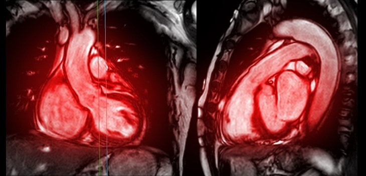 Image: A standard cardiac MRI could provide critical oxygen measurements without invasive catheter procedures (Photo courtesy of 123RF)