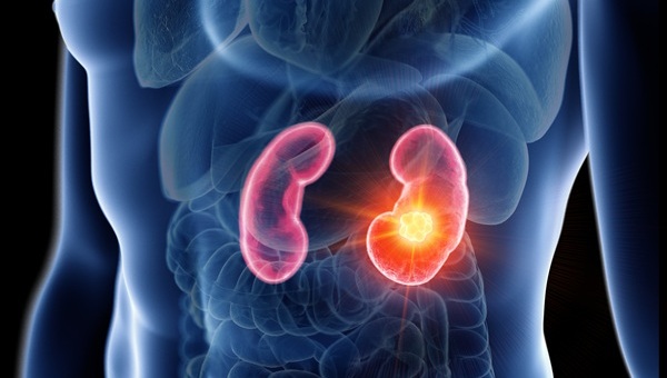 Image: Minimally invasive ablation matches surgery for small kidney cancers (Photo courtesy of 123RF)
