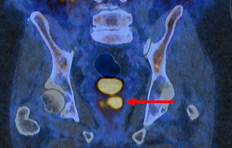 Image: PSMA PET/CT image showing glowing prostate cancer cells (photo courtesy of PRIMARY2 trial)