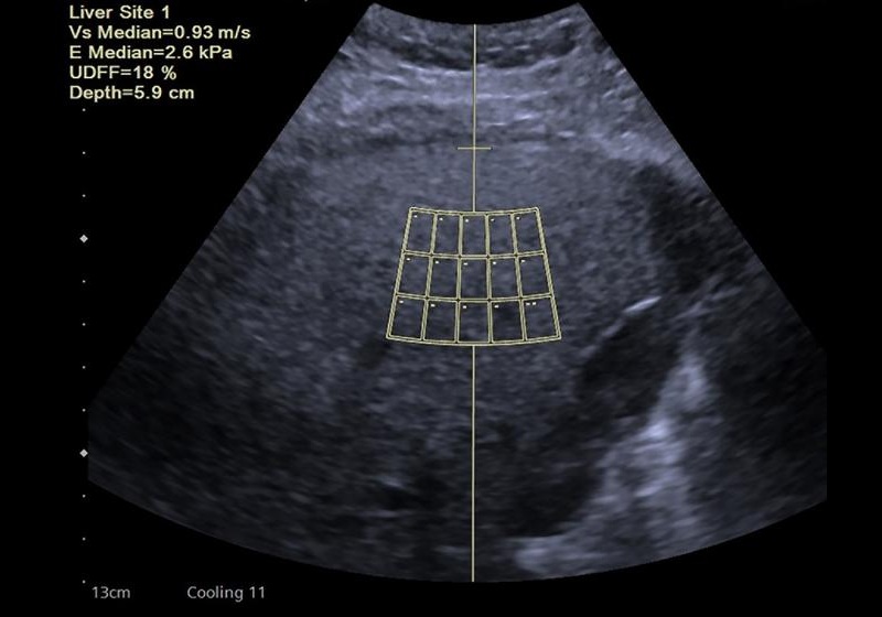 Image: Researchers developed an expert consensus to standardize UDFF use in clinical practice based on extensive literature review, expert experience and recent advances in MASLD diagnosis (Photo courtesy of Dr. Huixiong Xu and Dr. Hong Ding from Fudan University, China)