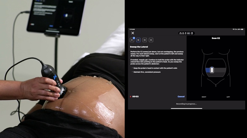Image: Butterfly Network’s fully automated Gestational Age (GA) Tool is the first FDA-cleared blind-sweep ultrasound AI application for estimating gestational age (photo courtesy of Butterfly Network)
