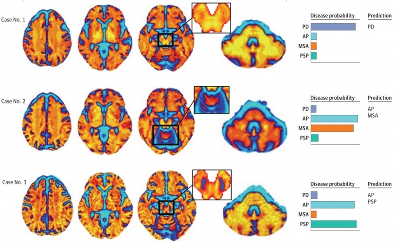 Image: The system analyzes diffusion MRI to classify MSA-P and PSP patterns, supporting differentiation from Parkinson’s disease (photo courtesy of Neuropacs Corp.) Image: The system analyzes diffusion MRI to classify MSA-P and PSP patterns, supporting differentiation from Parkinson’s disease (photo courtesy of Neuropacs Corp.)