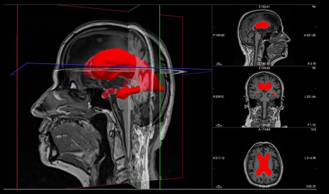 Image: Enlarged lateral ventricles of an idiopathic normal pressure hydrocephalus patient (photo courtesy of the University of Eastern Finland)