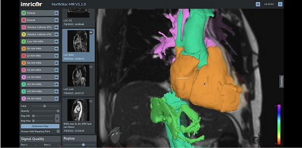 Image: Imricor\'s NorthStar Mapping System (photo courtesy of Imricor)