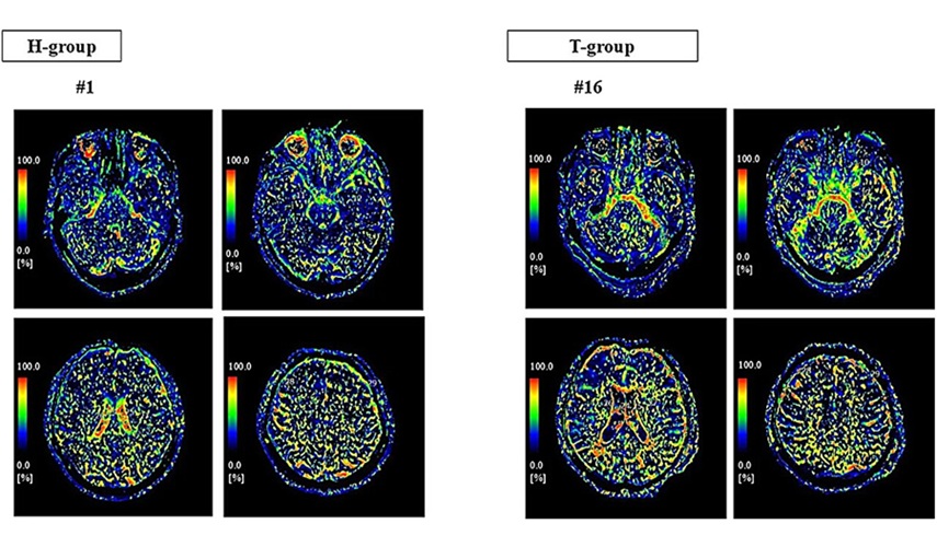 Image: Representative IVIM-derived f-maps from participants. The color bar represents the perfusion fraction (f), a unitless parameter ranging from 0 to 100% that reflects the fraction of incoherent motion-related signal within a voxel. Warmer colors indicate higher f-values, suggesting greater microdynamic motion within the CSF space (Watanabe S, Shibata Y and Ishikawa E. Frontiers in Neuroscience (2026). DOI: 10.3389/fnins.2026.1756207)