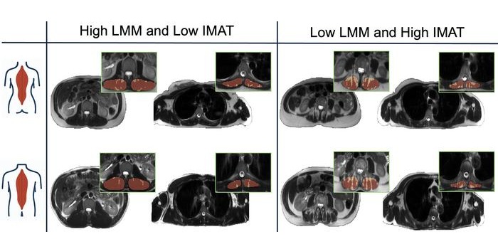 Image: Exemplary cases across four intermuscular adipose tissue (IMAT)–lean muscle mass (LMM) z score combinations. The figure shows four LMM-IMAT combinations in women (top row) and men (bottom row). From right to left, the panels show axial T2-weighted half-Fourier acquisition single-shot turbo spin-echo images of the thoracic and lumbar regions in individuals with high LMM and low IMAT and with low LMM and high IMAT (Photo courtesy of RSNA)