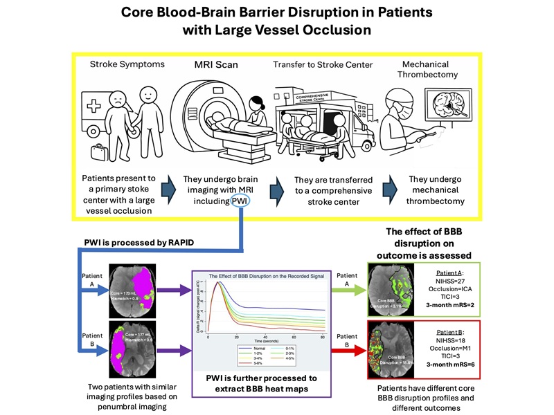 Image: Graphical Abstract (Richard Leigh et al. Core blood-brain barrier disruption in patients with large vessel occlusion. Stroke, 2026. doi:10.1161/STROKEAHA.126.055955)