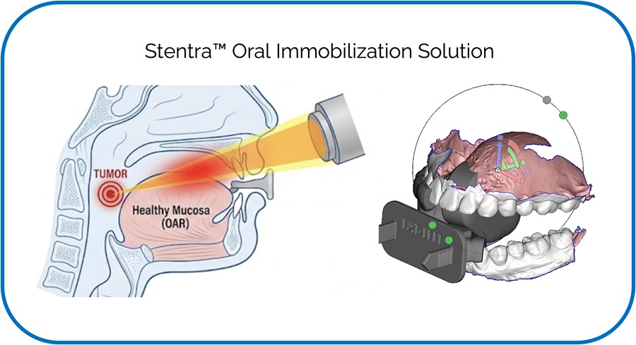 Image: FDA-cleared Stentra patient-tailored oral immobilization solution delivers a custom fit and case-specific tongue displacement to optimize dose delivery and protect healthy tissues in head and neck cancer radiation therapy (Photo courtesy of Kallisio)