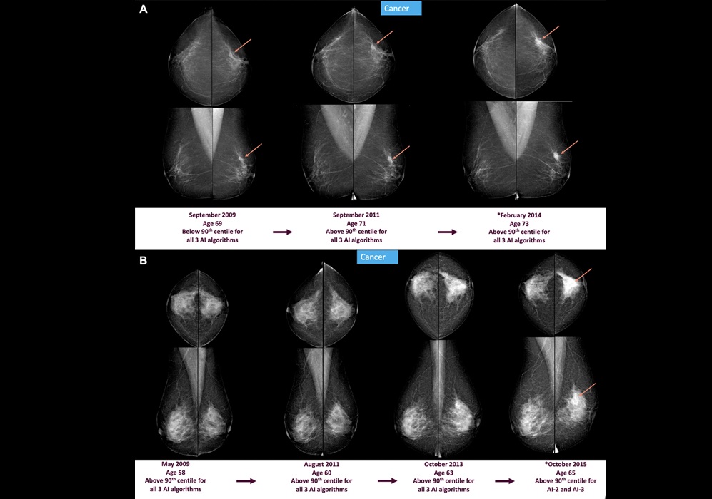Image: Screening mammograms and artificial intelligence (AI) score changes over time in two individuals with screen-detected cancer. Full-field digital mammograms show craniocaudal (top) and mediolateral (bottom) views of the left and right breast (Photo courtesy of Radiological Society of North America)
