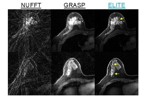 Image: Video and scientific image caption: Demonstration of ELITE results in two patients — a technology that provides high temporal and spatial resolution, reduces noise, and enhances the visualization of breast tumor (marked in yellow) and blood vessels morphology (Photo courtesy of Dr. Eddy Solomon/Technion - Israel Institute of Technology)