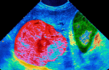 Image: Colored ultrasound scan of a malignant tumor (red) in a patient’s liver (Photo courtesy of Camal, ISM / SPL).