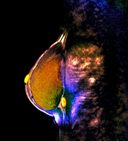 Image: Colored magnetic resonance imaging (MRI) scan of the breast of a 50-year-old woman with breast cancer (Photo courtesy of Zephyr / SPL).