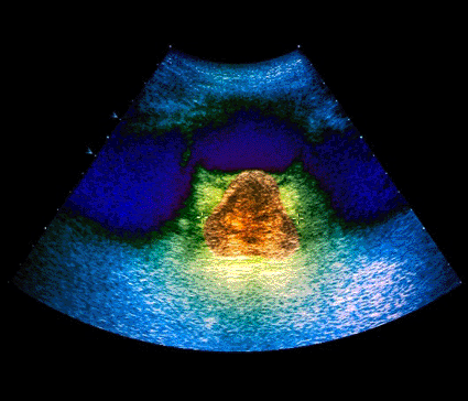 Image: Colored ultrasound scan of a section through the pelvis of a 52-year-old man with an adenoma of the prostate gland (Photo courtesy of Zephyr / SPL).