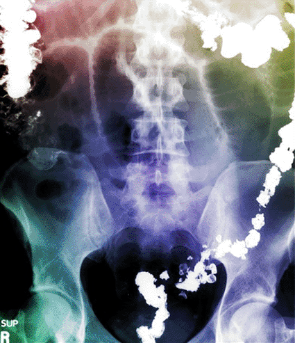 Image: Color-enhanced abdominal X-ray showing the typical appearance of a small bowel obstruction. The white density is barium within the large intestine, which was introduced by a barium enema exam (Photo courtesy of Living Art Enterprises).