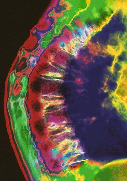 Image: Computer-enhanced X-ray of the curved and deformed thoracic spine of a woman suffering from osteoporosis (Photo courtesy of Mehau Kulyk).