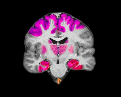 Image: Color-enhanced coronal MRI image of the brain, showing the regions of the brain most severely affected in Alzheimer’s disease (Photo courtesy of Living Art Enterprises).