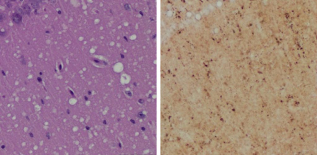 Image: A Microscopic examination of brain tissues of prion-infected animals. (Left) Staining shows spongiform degeneration. (Right) Staining shows intense misfolded prion protein (Photo courtesy of Case Western Reserve University). Image: A Microscopic examination of brain tissues of prion-infected animals. (Left) Staining shows spongiform degeneration. (Right) Staining shows intense misfolded prion protein (Photo courtesy of Case Western Reserve University).