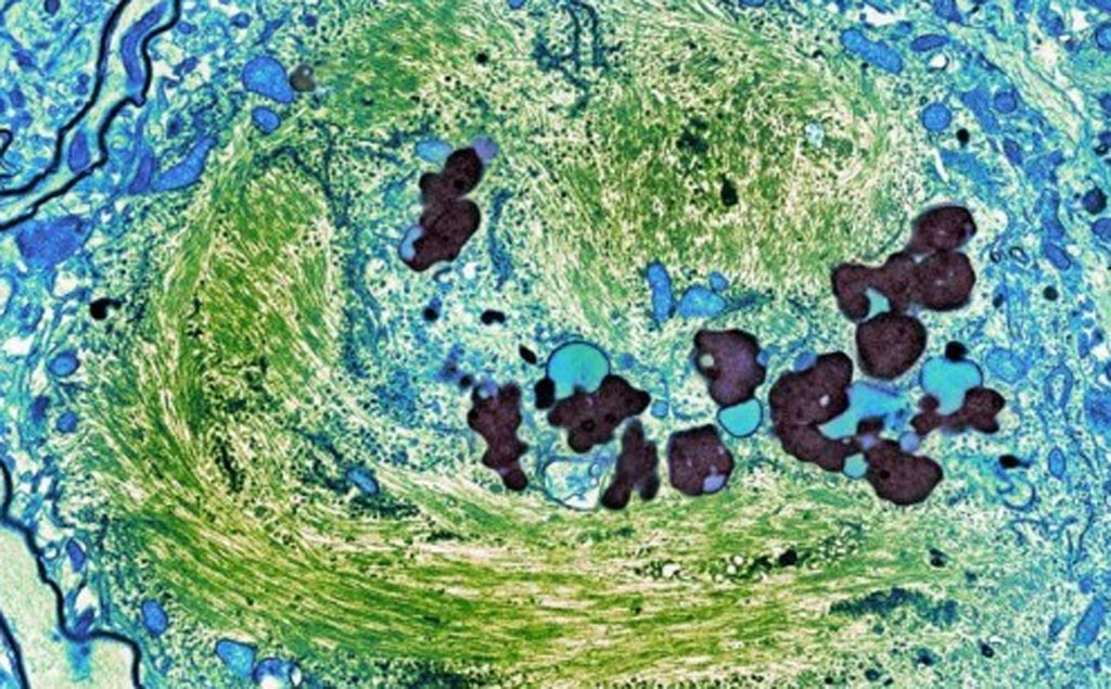 Image: A micrograph showing tangles of tau protein (green) in the brain cell of a person who had Alzheimer’s disease (Photo courtesy of Thomas Deerinck of the National Center for Microscopy and Imaging Research at the University of Califronia, San Diego School of Medicine). Image: A micrograph showing tangles of tau protein (green) in the brain cell of a person who had Alzheimer’s disease (Photo courtesy of Thomas Deerinck of the National Center for Microscopy and Imaging Research at the University of Califronia, San Diego School of Medicine).