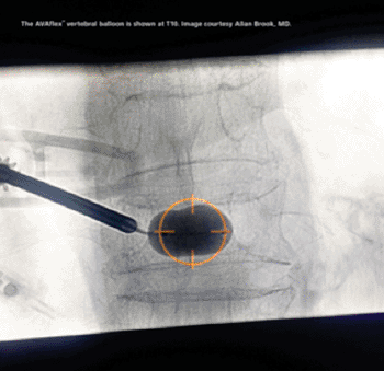 Imagen: El Sistema de Globo Vertebral AVAflex colocado en el nivel vertebral L10 (Fotografía cortesía de CareFusion).