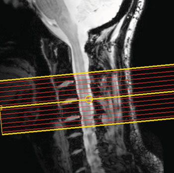 Imagen A: Los niveles de actividad de diferentes partes de la médula espinal de personas en reposo se midieron utilizando fMRI (Fotografía cortesía de Barry RL, Smith SA, Dula AN, et al, revista eLIFE, 5 de agosto de 2014). Imagen A: Los niveles de actividad de diferentes partes de la médula espinal de personas en reposo se midieron utilizando fMRI (Fotografía cortesía de Barry RL, Smith SA, Dula AN, et al, revista eLIFE, 5 de agosto de 2014).