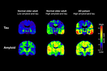 Imagen: Exámenes PET siguiendo a tau y β-amiloide a partir de dos personas mayores normales y un paciente con EA (Fotografía cortesía de Michael Schöll/UC Berkeley). Imagen: Exámenes PET siguiendo a tau y β-amiloide a partir de dos personas mayores normales y un paciente con EA (Fotografía cortesía de Michael Schöll/UC Berkeley).