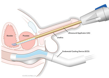 Imagen: El sistema PRO para la ablación transuretral por ultrasonido (TULSA) (Fotografía cortesía de Profound Medical).