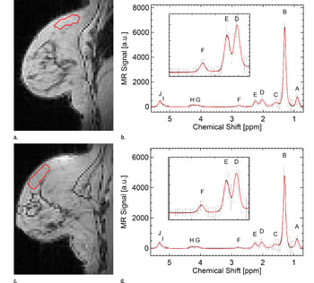 Imagen: Los resultados del análisis de una mujer post-menopáusica con una lesión benigna y una mujer post-menopáusica con carcinoma ductal invasivo, usando la técnica nueva de RM (Fotografía cortesía de RSNA).