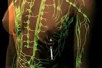 Imagen: Una biopsia del ganglio linfático centinela para el diagnóstico del cáncer de mama (Fotografía cortesía de CancerQuest). Imagen: Una biopsia del ganglio linfático centinela para el diagnóstico del cáncer de mama (Fotografía cortesía de CancerQuest).