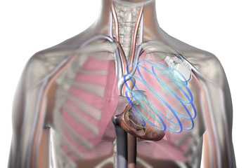 Imagen: La monitorización del estado de los líquidos OptiVol para monitorizar la falla cardiaca en el pacientes con un ICD de Medtronic (Fotografía cortesía de Medtronic). Imagen: La monitorización del estado de los líquidos OptiVol para monitorizar la falla cardiaca en el pacientes con un ICD de Medtronic (Fotografía cortesía de Medtronic).
