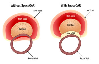 Imagen: Los beneficios del sistema SpaceOAR (Fotografía cortesía de Augmenix).