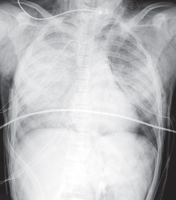 Imagen: Una radiografía AP del pecho, de un adolescente de 16 años, implicado en un volcamiento de un vehículo todo terreno (Fotografía cortesía de Radiology Key). Imagen: Una radiografía AP del pecho, de un adolescente de 16 años, implicado en un volcamiento de un vehículo todo terreno (Fotografía cortesía de Radiology Key).