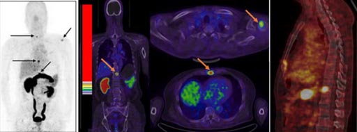 Imagen: El nuevo trazador muestra los tumores en un hombre de 64 años con cáncer de próstata (Fotografía cortesía del NIBIB).