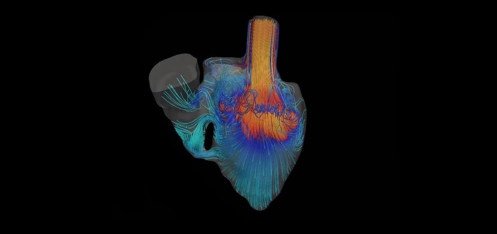 Imagen: Una simulación que muestra la sangre fluyendo a través del corazón de un bebé nacido con un defecto (Fotografía cortesía del Laboratorio Marsden/Universidad de Stanford).
