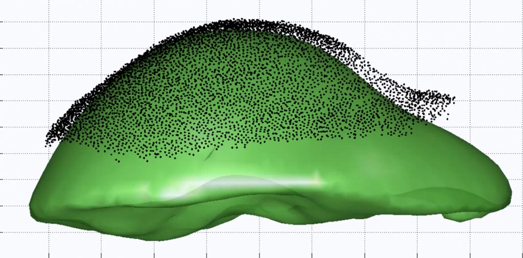 Imagen: Desparidad entre la forma del hígado en una tomografía computarizada (verde) y el rastreo intraoperatorio (Fotografía cortesía de la Universidad de Vanderbilt).