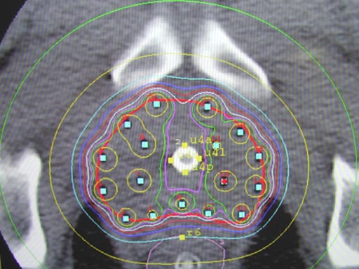 Imagen: Un ejemplo de tratamiento de braquiterapia para los pacientes con cáncer de próstata (Fotografía cortesía de UCLA Health).
