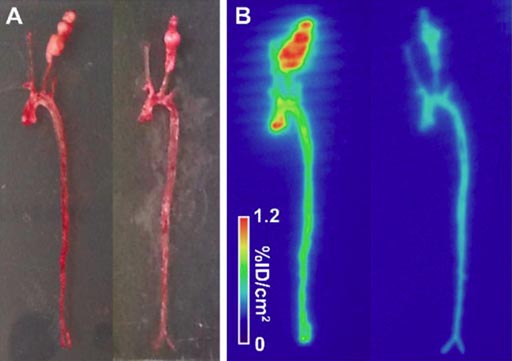 Imagen: Un nuevo trazador de imagenología puede ayudar a detectar el riesgo de aneurisma de aorta abdominal (Fotografía cortesía de la Universidad de Yale). Imagen: Un nuevo trazador de imagenología puede ayudar a detectar el riesgo de aneurisma de aorta abdominal (Fotografía cortesía de la Universidad de Yale).