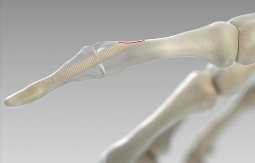 Imagen: La investigación sugiere que los tornillos ortopédicos hechos de hueso humano pronto podrían reemplazar los de metal (Fotografía cortesía de Surgebright).