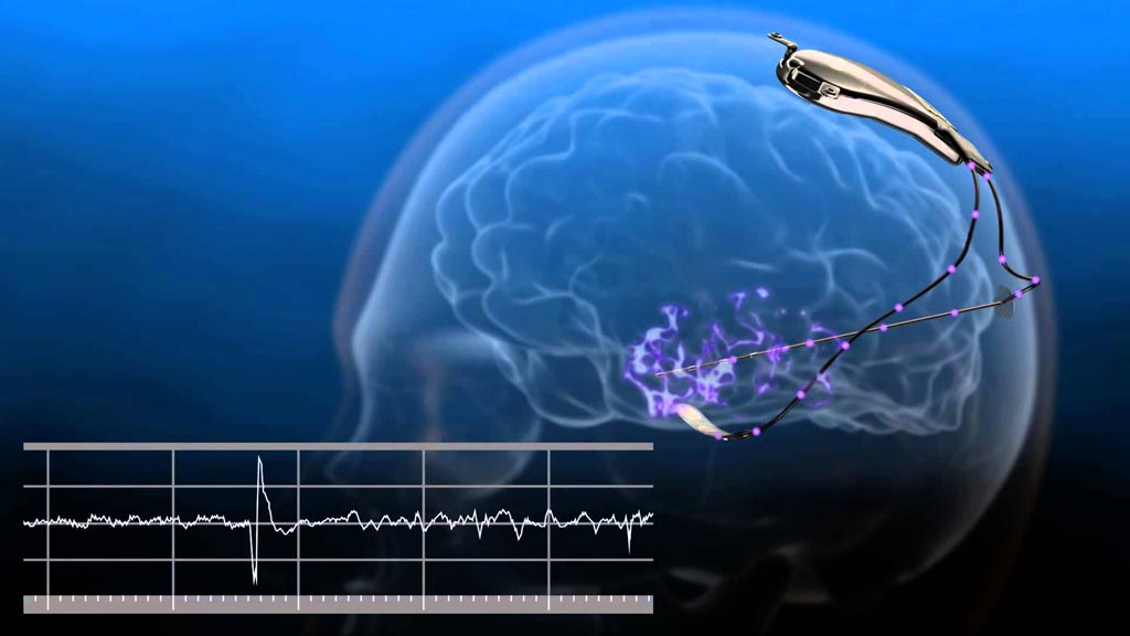 Imagen: Se puede usar el sistema NeuroPace RNS para predecir un ataque de epilepsia (Fotografía cortesía de NeuroPace).