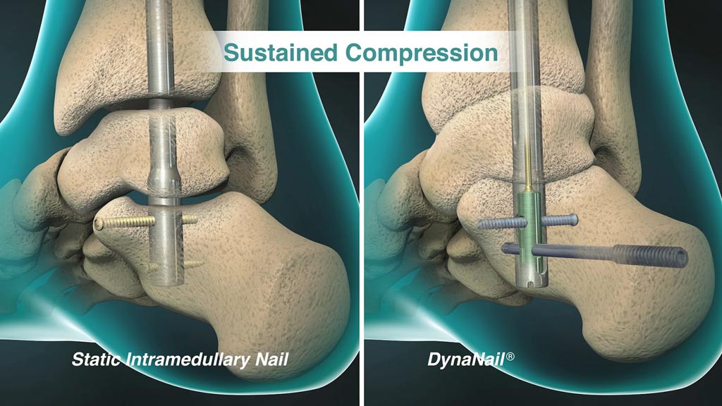 Imagen: El elemento de compresión interno DynaNail XL se adapta automáticamente a los cambios en la articulación (Fotografía cortesía de MedShape).