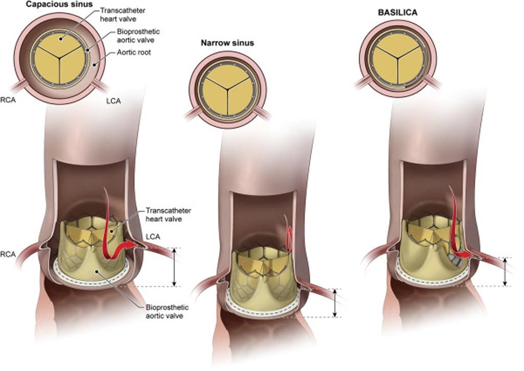 Imagen: La laceración de la válvula aórtica reduce el riesgo de obstrucción después del TAVR (Fotografía cortesía del NHBLI).