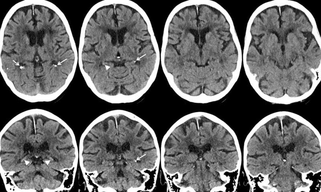 Imagen: Las imágenes axiales y coronales con la TC muestran calcificación leve del hipocampo (flechas) (Fotografía cortesía de la RSNA). Imagen: Las imágenes axiales y coronales con la TC muestran calcificación leve del hipocampo (flechas) (Fotografía cortesía de la RSNA).